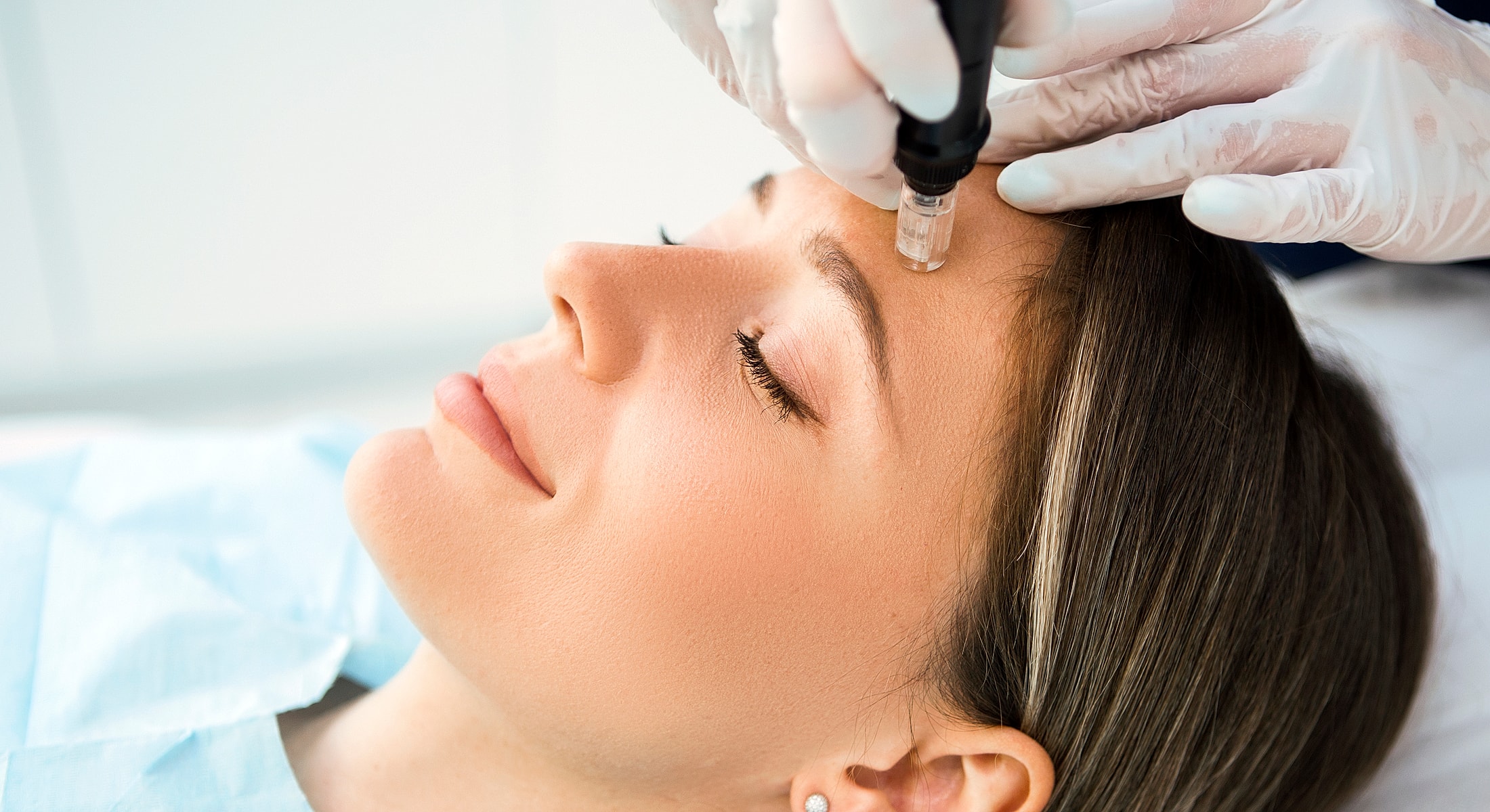 Micro-needling procedure on a woman's forehead.